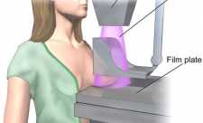 Mamografia, este recomandata sau nu?